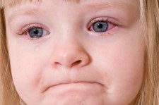 Pinkeye (Conjunctivitis) | Caring for kids