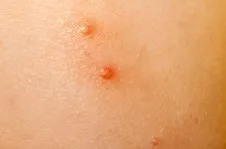 Molluscum contagiosum