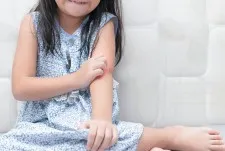 Ringworm
